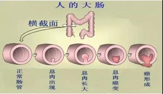 體檢發(fā)現(xiàn)腸息肉會(huì)癌變嗎？